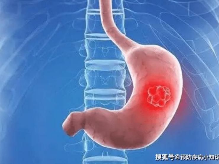 Sức khỏe đời sống - Người đau dạ dày nên hạn chế ăn 3 loại rau này