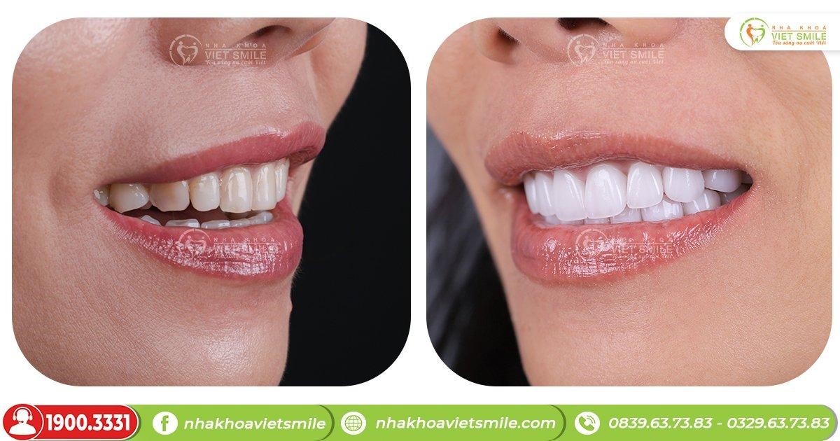 Bật mí những dịch vụ giúp nâng cấp nụ cười tại Nha khoa VIET SMILE - 2