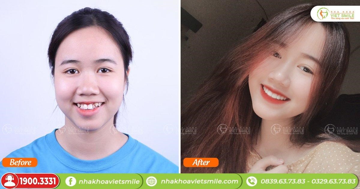 Bật mí những dịch vụ giúp nâng cấp nụ cười tại Nha khoa VIET SMILE - 3