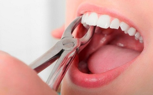 Lịch sử nhổ răng: Thời cổ đại như hình thức tra tấn đến sự phát triển của nha khoa hiện đại - 3