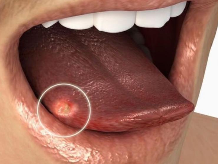 Tê bì, gai gợn ở lưỡi, dấu hiệu nhận biết sớm nhất của ung thư lưỡi
