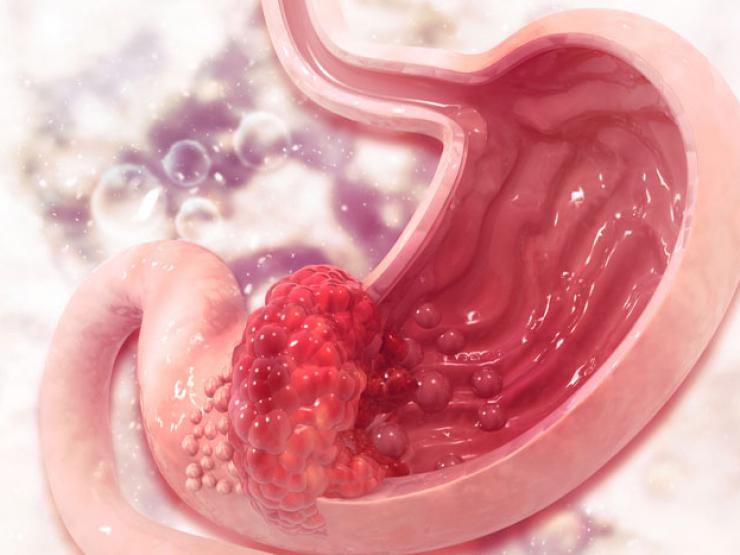 Sức khỏe đời sống - Những triệu chứng sớm nhất của bệnh ung thư, nam giới cần biết