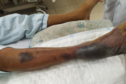 Sức khỏe đời sống - Người đàn ông hoại tử chân, suy gan thận rối loạn đông máu do loại vi khuẩn này