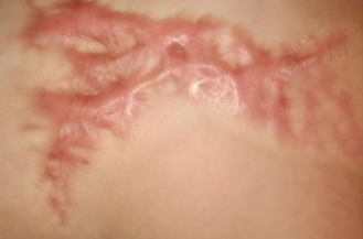 Vết sẹo trên đùi là nỗi ám ảnh và tự ti của Yến