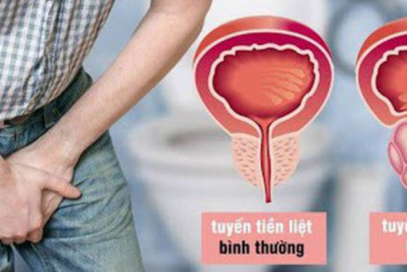 4 thói quen tăng nguy cơ gây ung thư tuyến tiền liệt, nam giới tuyệt...