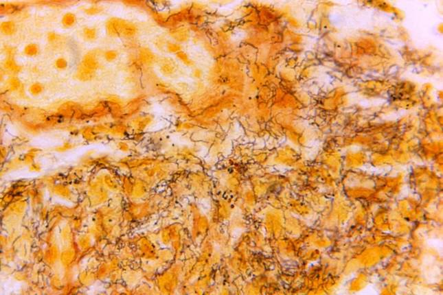 Một mẫu mô có sự hiện diện của rất nhiều xoắn khuẩn Treponema pallidum, hình xoắn ốc, nhuộm màu sẫm, loại vi khuẩn gây ra bệnh giang mai.