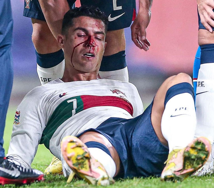 Ronaldo đổ máu khi trận đấu mới diễn ra được hơn 10 phút