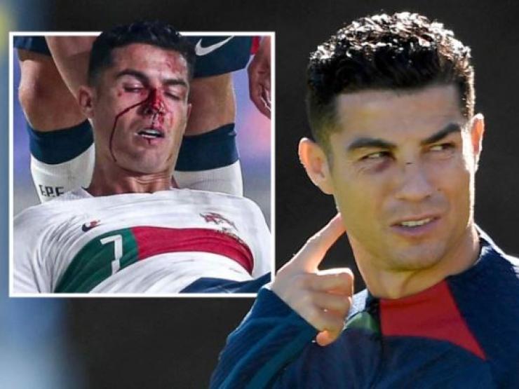 Ronaldo bị bầm tím mắt vẫn muốn phá dớp trước TBN, dính thêm rắc rối vì fan nhí