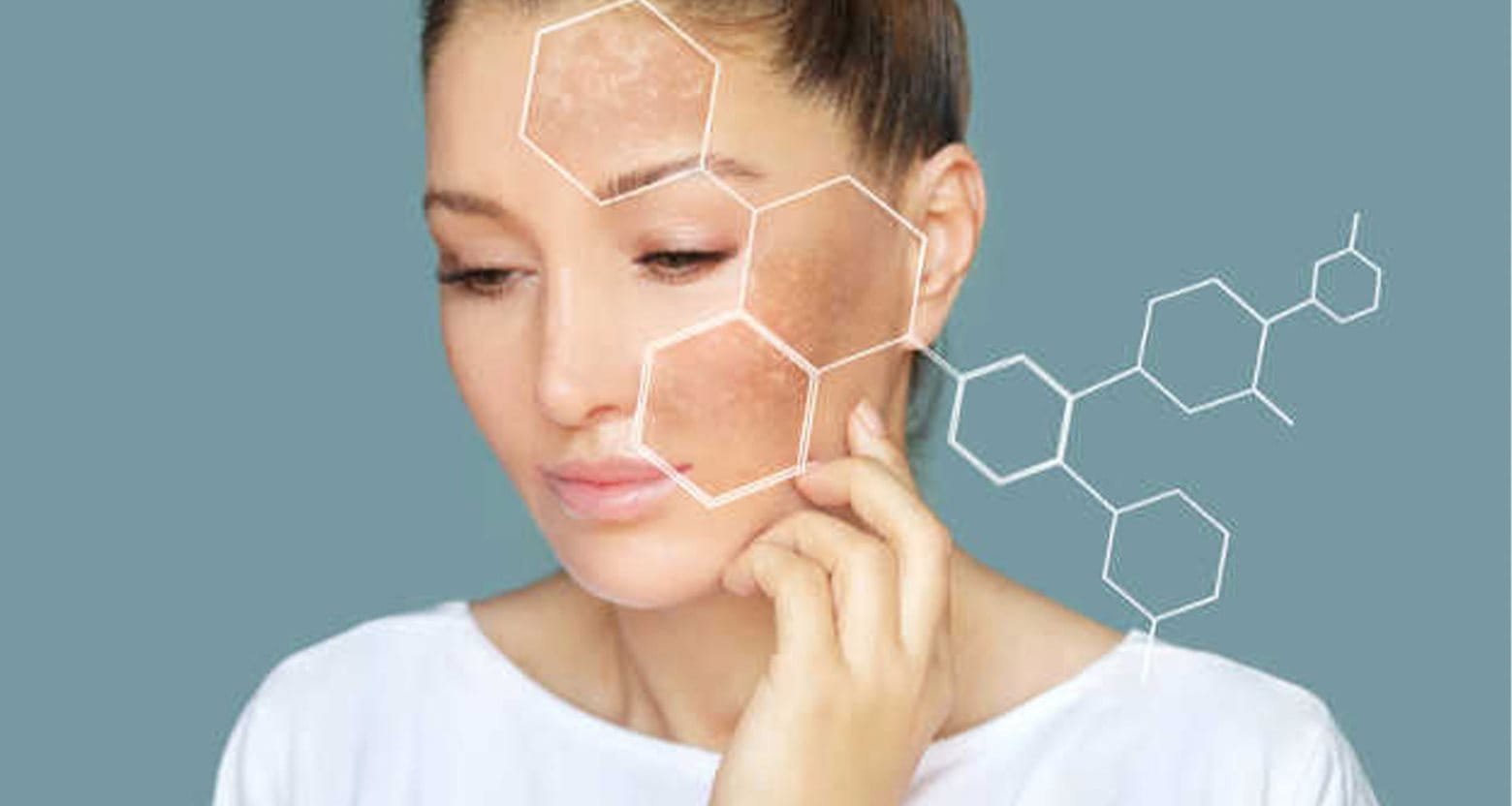 Kem ức chế nám Melasma Cream Ba12days phát huy hiệu quả sau bao lâu? - 3