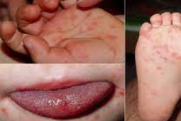 Bệnh tay chân miệng có thể biến chứng nguy hiểm, cần đưa vào viện nếu có 3 dấu hiệu này