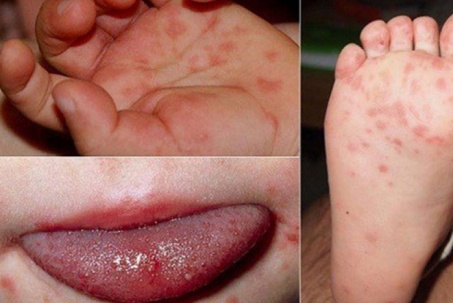 40% trẻ mắc tay chân miệng do chủng virus nguy hiểm, cách chăm sóc trẻ để tránh biến chứng