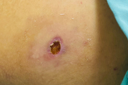 Sức khỏe đời sống - Sốt mò đang quay trở lại, biến chứng nguy hiểm có thể gây tử vong