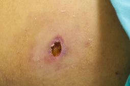 Sức khỏe đời sống - Sốt mò đang quay trở lại, biến chứng nguy hiểm có thể gây tử vong