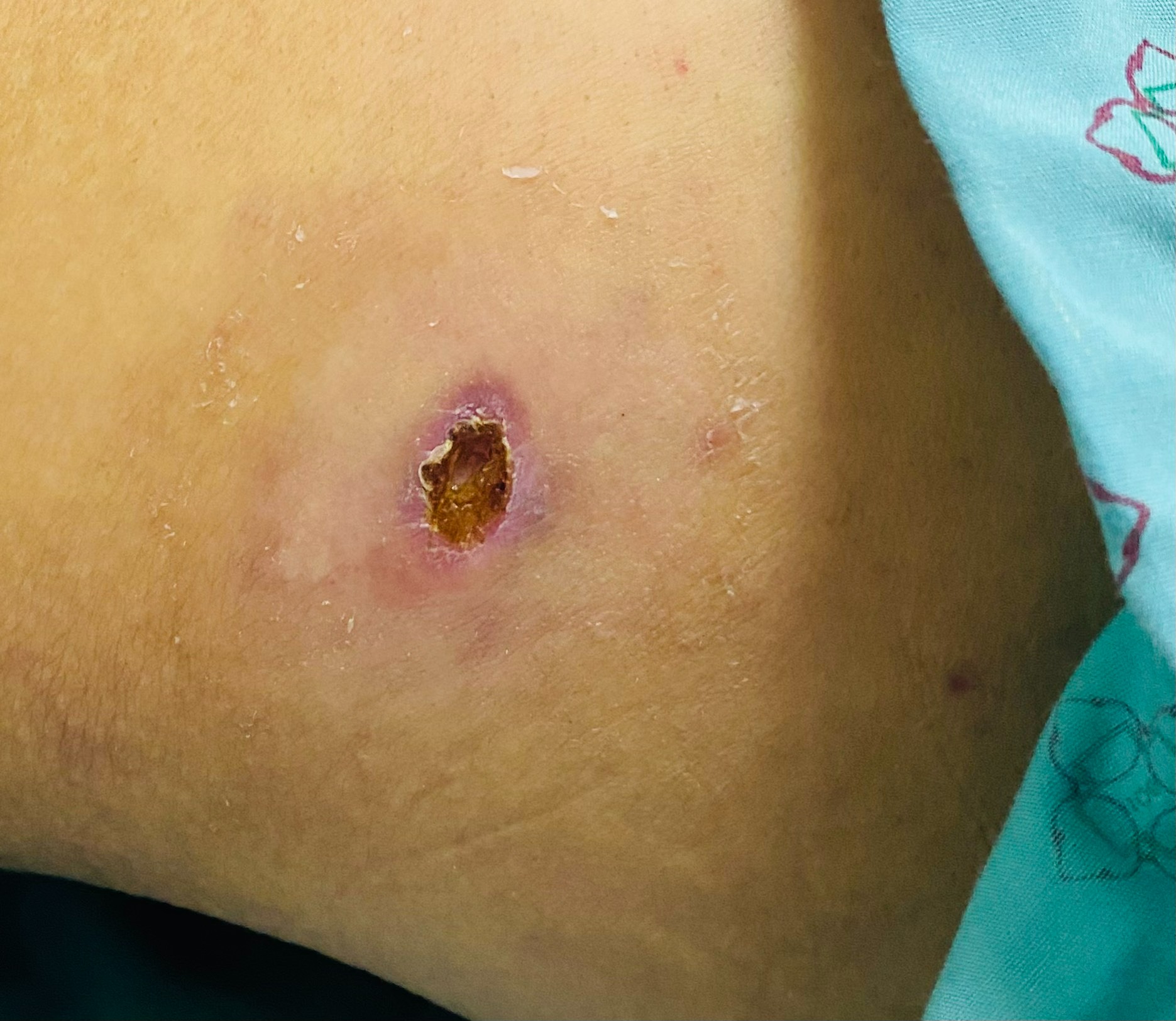 Vết sốt mò điển hình của bệnh nhân đang điều trị tại Khoa Bệnh lây đường tiêu hóa.