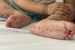 Cảnh báo: Dịch tay chân miệng lan khắp cả nước, chủng virus EV71 gây biến chứng nặng ở nhiều trẻ