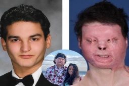 Bạn trẻ - Cuộc sống - Chàng trai bỏng 80% cơ thể đã tìm thấy tình yêu