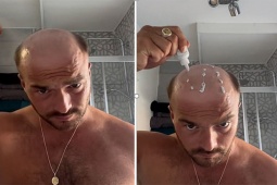 Bạn trẻ - Cuộc sống - Chàng trai bị hói ở tuổi 23 biến hóa mái tóc đáng kinh ngạc