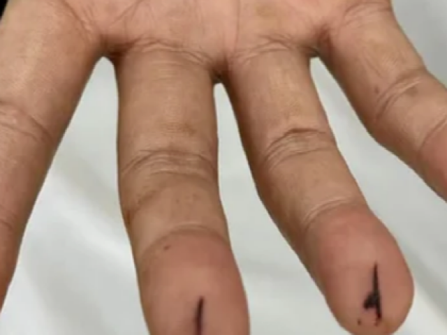 Sức khỏe đời sống - Nặn "máu độc" chữa đột quỵ, người đàn ông nguy kịch