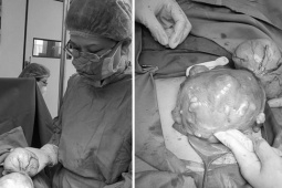 Sức khỏe đời sống - Kinh nguyệt quá nhiều, người phụ nữ đi khám phát hiện u xơ tử cung to bằng thai nhi 5 tháng