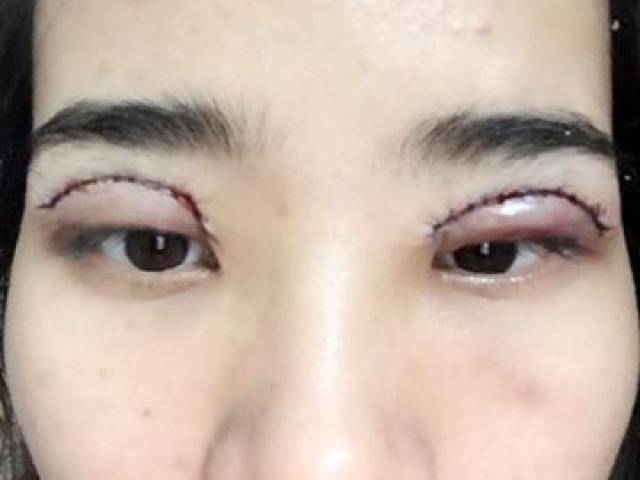 Cô gái 23 tuổi ở Hà Nội mù mắt vì cắt mí ở spa