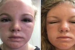 Sức khỏe đời sống - Cô gái bị cháy nắng kinh hoàng khiến gương mặt bị biến dạng như “người ngoài hành tinh”