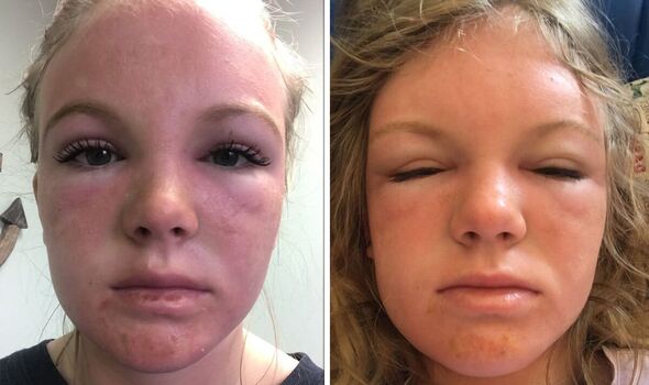Cô gái bị cháy nắng kinh hoàng khiến gương mặt bị biến dạng như “người ngoài hành tinh” - 1