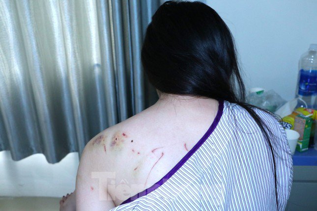 Cơ thể đầy vết thương của chị T.