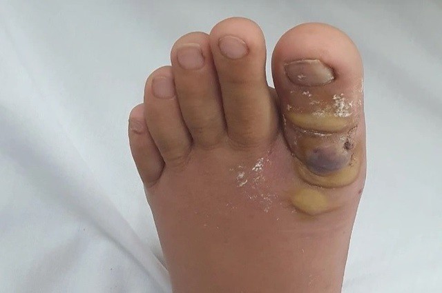 Hình ảnh ngón chân trái của bệnh nhân sưng tấy, mưng mủ