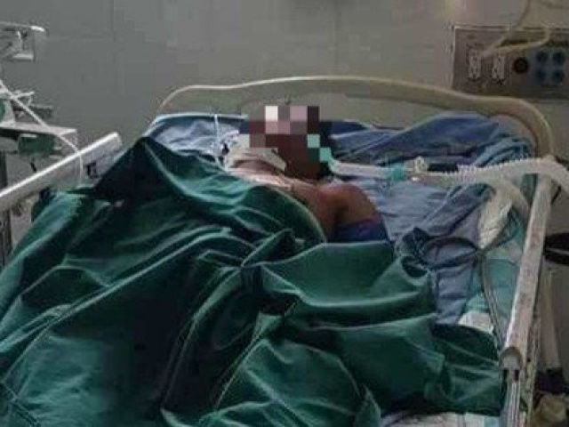 Sức khỏe đời sống - Người đàn ông nguy kịch vì ong vò vẽ đốt