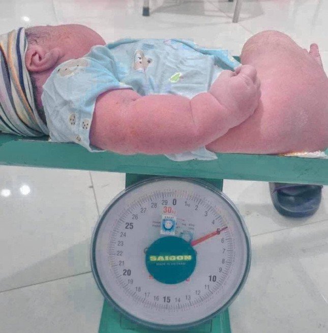 Sản phụ sinh thường bé trai nặng 5kg