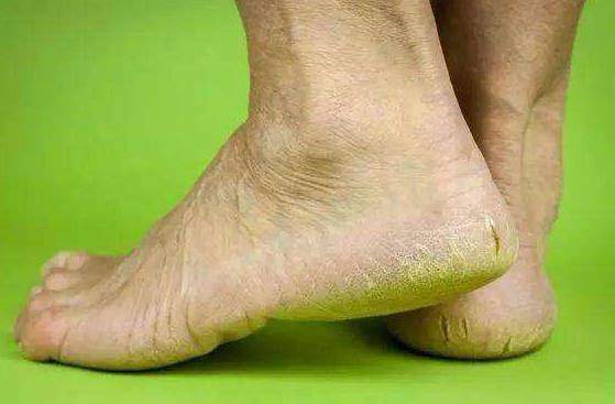 Thấy 5 dấu hiệu này ở bàn chân bạn nên chụp CT gan sớm - 3