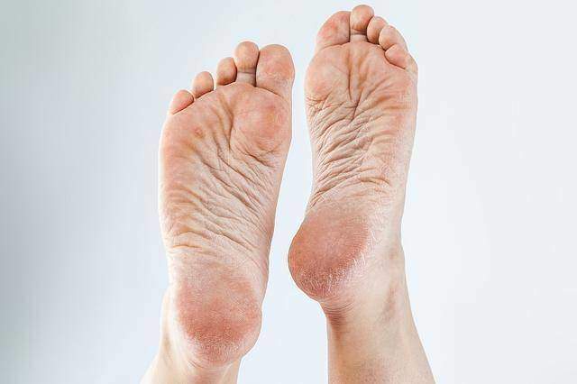 Thấy 5 dấu hiệu này ở bàn chân bạn nên chụp CT gan sớm - 4