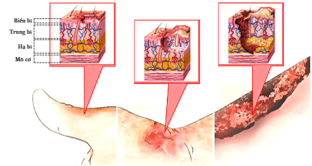 Gel Silicone: Bí quyết đơn giản để quản lý với sẹo bỏng - 1