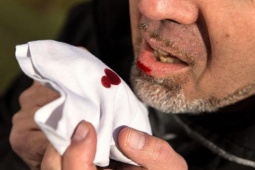 Sức khỏe đời sống - Cảnh báo ung thư thực quản cận kề: Đừng vì “đợi” trào ngược giảm mà hối hận không kịp!