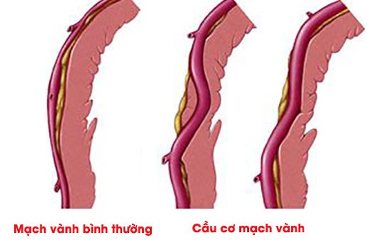 Cầu cơ tim gây hẹp mạch vành