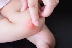 Sức khỏe đời sống - Cách giảm ngứa tức thì khi bị muỗi đốt, tiếc là đã không biết sớm hơn