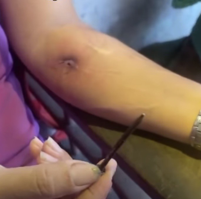 Cây đinh rút ra từ vết thương trên cánh tay. Ảnh: trích xuất từ video