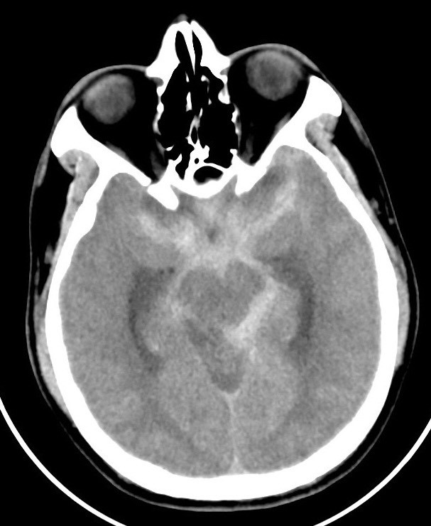 Hình ảnh xuất huyết não do vỡ phình mạch của bệnh nhân 37 tuổi trên phim chụp cắt lớp vi tính.