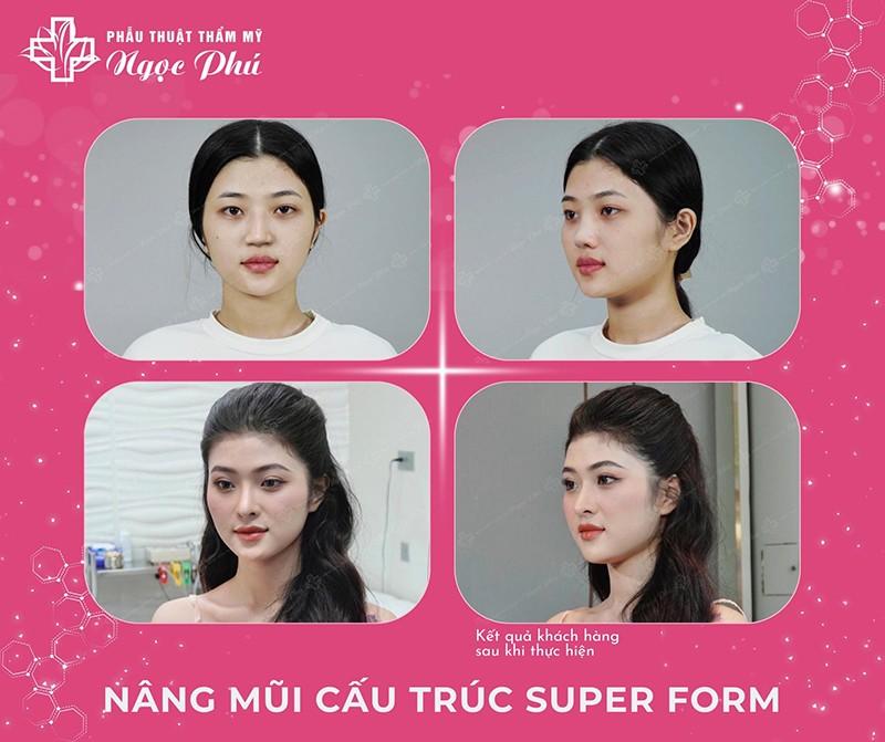 Nâng mũi Super Form – bước tiến mới trong thẩm mỹ mũi - 3