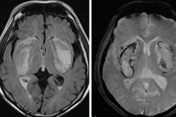 Sức khỏe đời sống - Mù mắt, hôn mê vì uống cồn giả pha nước lọc