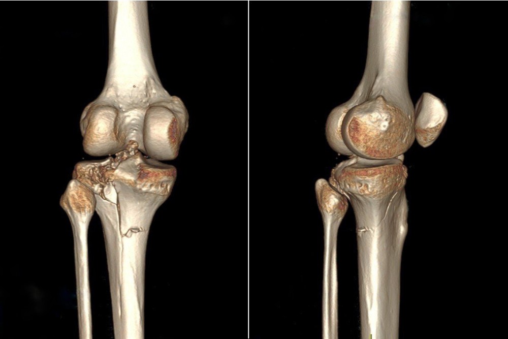 Hình ảnh gãy xương trên phim chụp CT