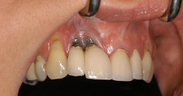 Biến chứng đào thải trụ khi trồng răng Implant kém chất lượng
