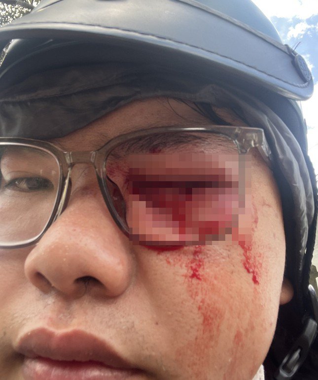 Mắt trái của anh N bị thương sau khi "va" vào gậy CSGT. Ảnh: Nhân vật cung cấp.