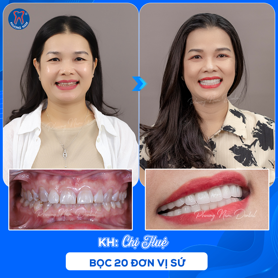 Bác sĩ Ngô Tùng Phương kiến tạo nụ cười hoàn hảo từ sự kết hợp Invisalign và răng sứ thẩm mỹ - 3