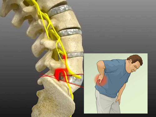 Thoát vị đĩa đệm chèn ép dây thần kinh gây đau lưng