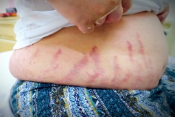 Sức khỏe đời sống - Hai anh em ruột bị rậm lông vì dùng thuốc xịt mũi suốt 3 năm