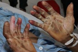 Sức khỏe đời sống - Người đàn ông 50 tuổi tử vong sau 2 ngày mệt, sốt cao