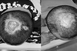 Sức khỏe đời sống - 2 bệnh nhân ở Hà Nội bị hoại tử, lở loét da đầu vì tẩy tóc