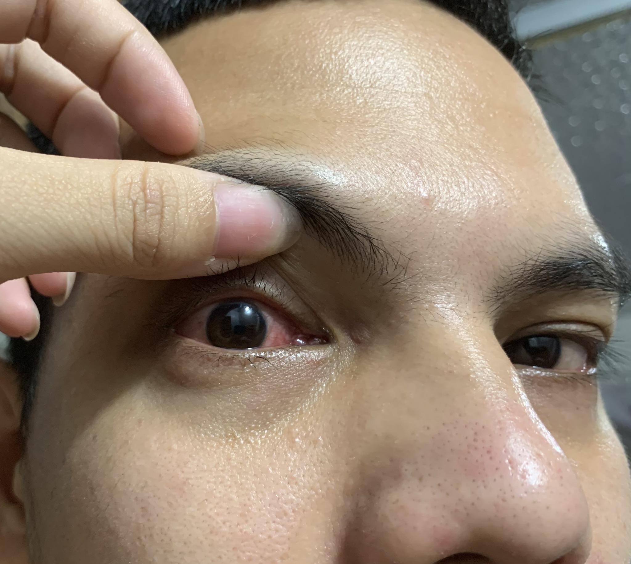 Dịch đau mắt đỏ lây lan nhanh, nhiều người biến chứng nặng - 2