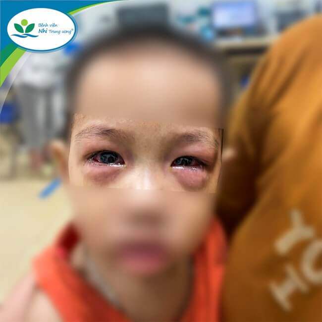 Trẻ bị đau mắt đỏ điều trị tại bệnh viện.